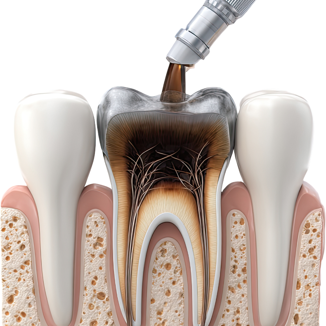Kanal Tedavisi ve Dolgu